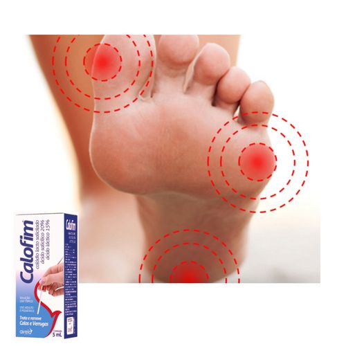 Calofim Para Calos E Verrugas 5ml Adulto E Pediatrico Calofim Para Calos E Verrugas 5ml Adulto E Pediatrico